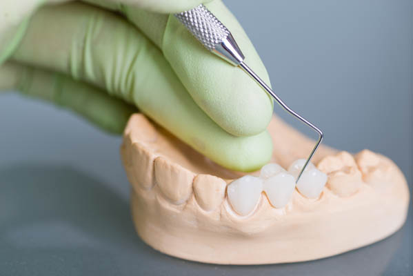 What Are Dental Bridges?