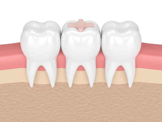 Tips For Extending The Longevity Of Dental Fillings