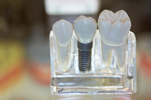 Replacing A Missing Tooth With A Single Dental Implant