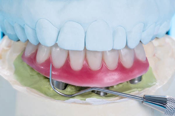 Implant Supported Dentures Houston, TX